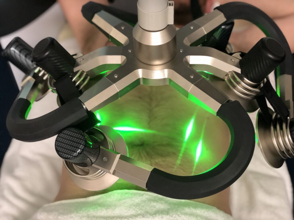 Zielone światło lasera Verju na skórze podczas zabiegu